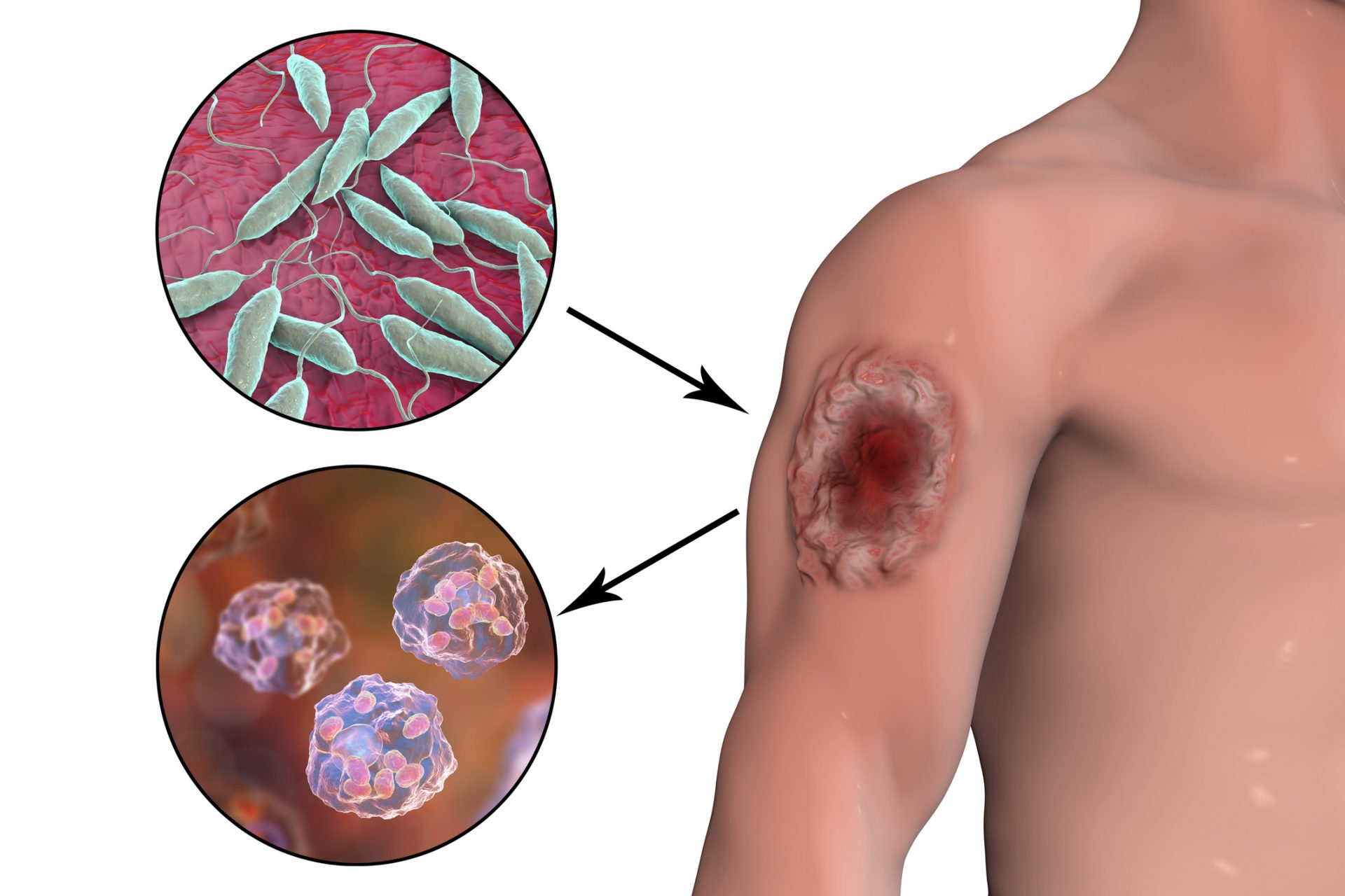 Symptoms of cutaneous leishmania