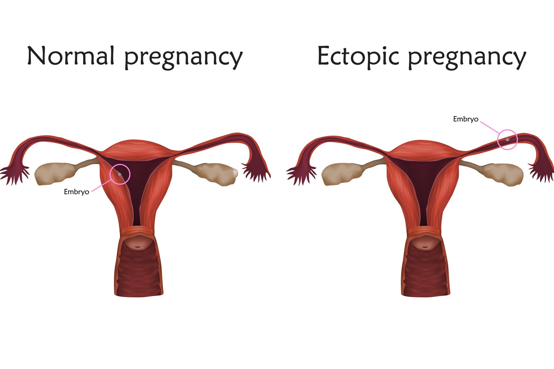 Delays in treatments for ectopic pregnancies 