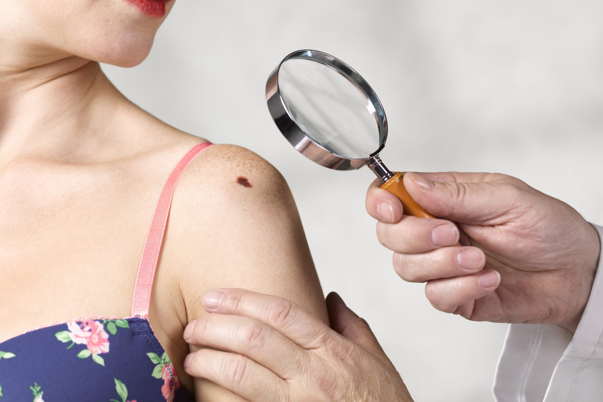 Estamos prestes a ter uma vacina contra o câncer de pele
