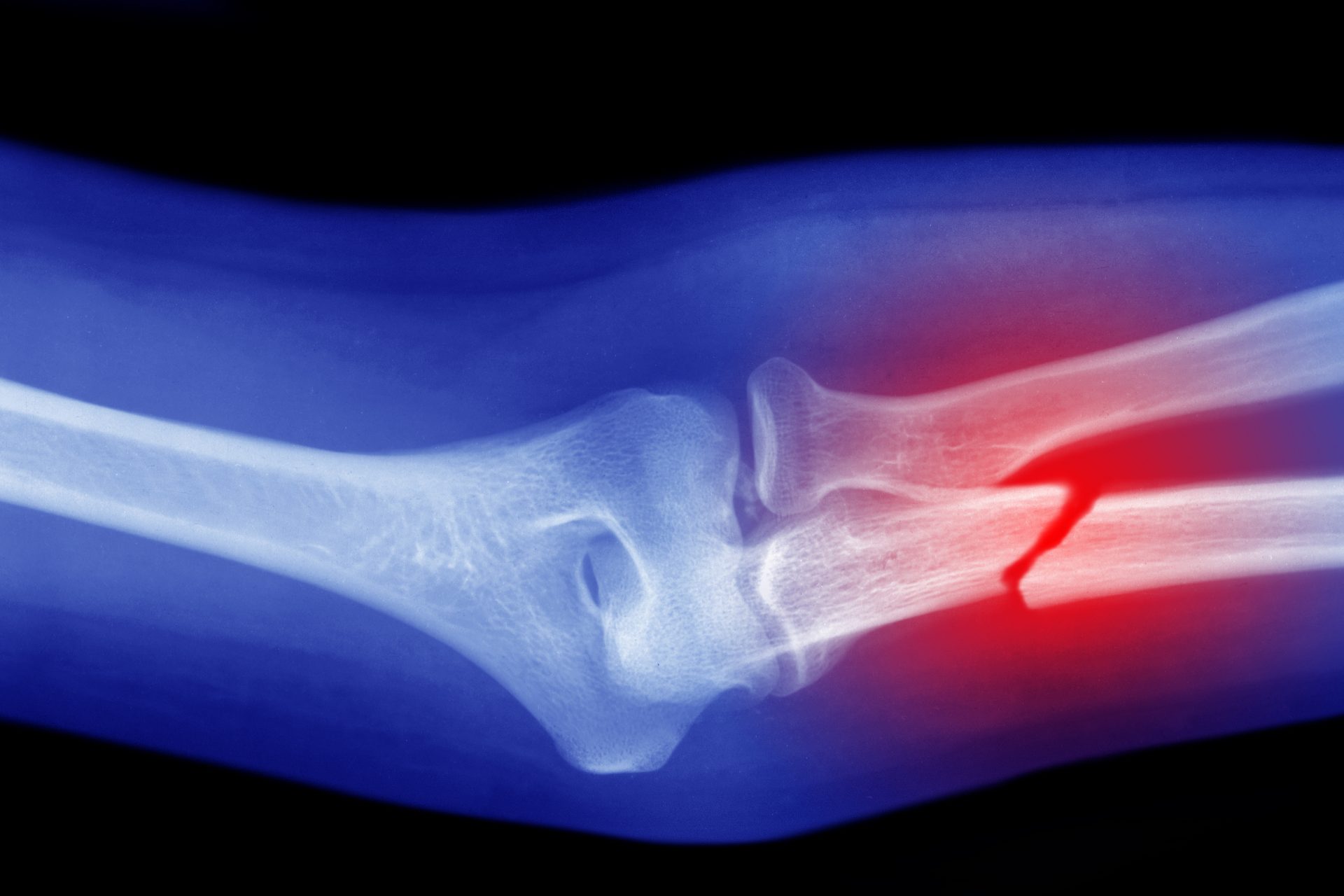 Menos lesiones musculares pero mayor riesgo de reducción de densidad ósea
