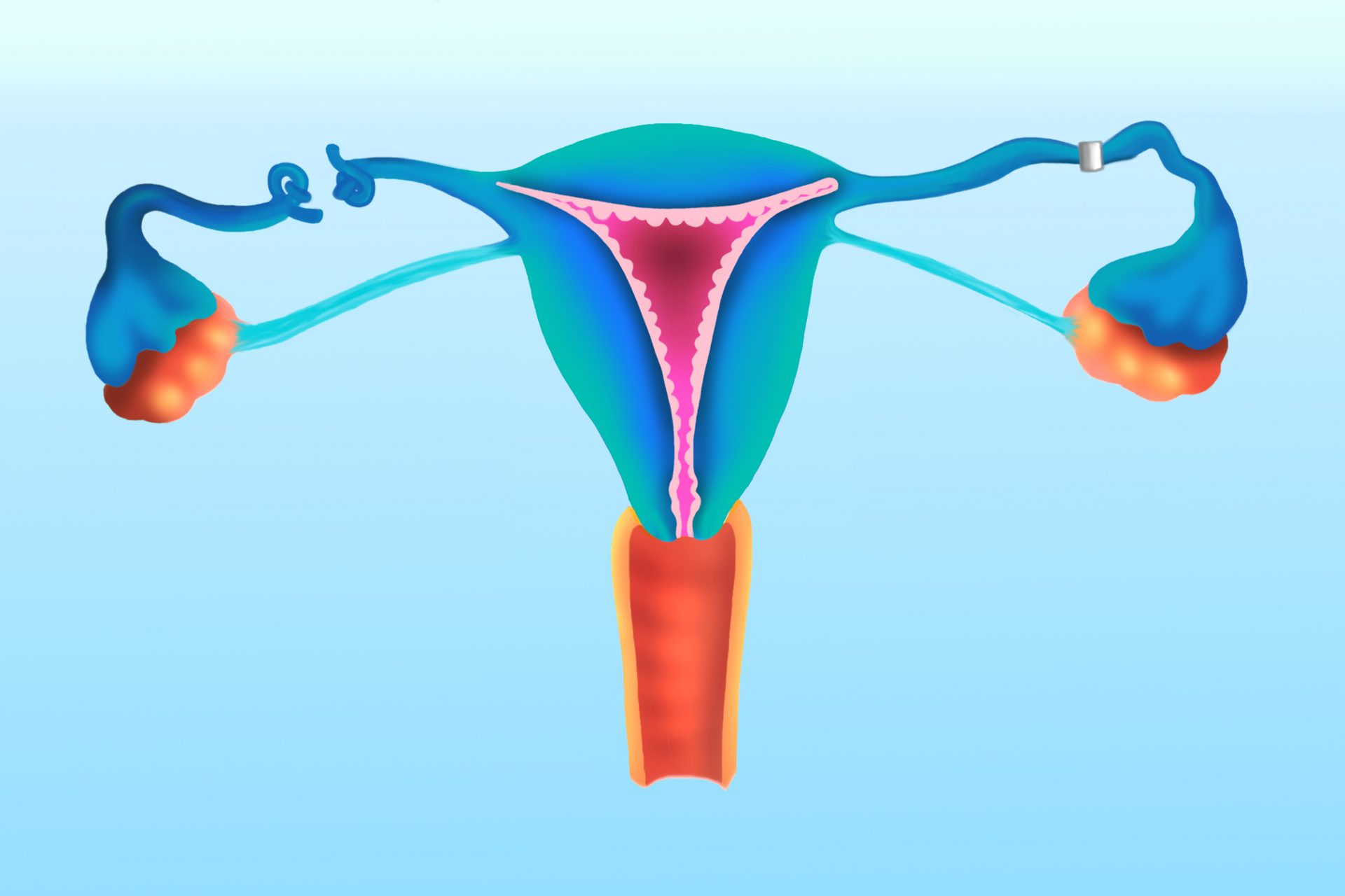 A dramatic increase in tubal ligations